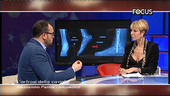 Artrosi di Caviglia, intervista al Dr. Alessandro Parma