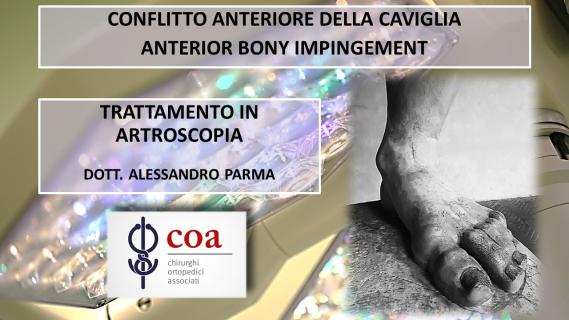 Conflitto - Impingement Anteriore Osseo di Caviglia - Artroscopia - Dott. Alessandro Parma
